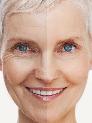 Fine Lines & Wrinkles Treatment | Aesthetipedia.com