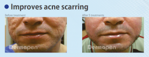 Skin Needling Improves Acne Scars