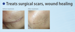 Skin Needling Improves Surgical Scars