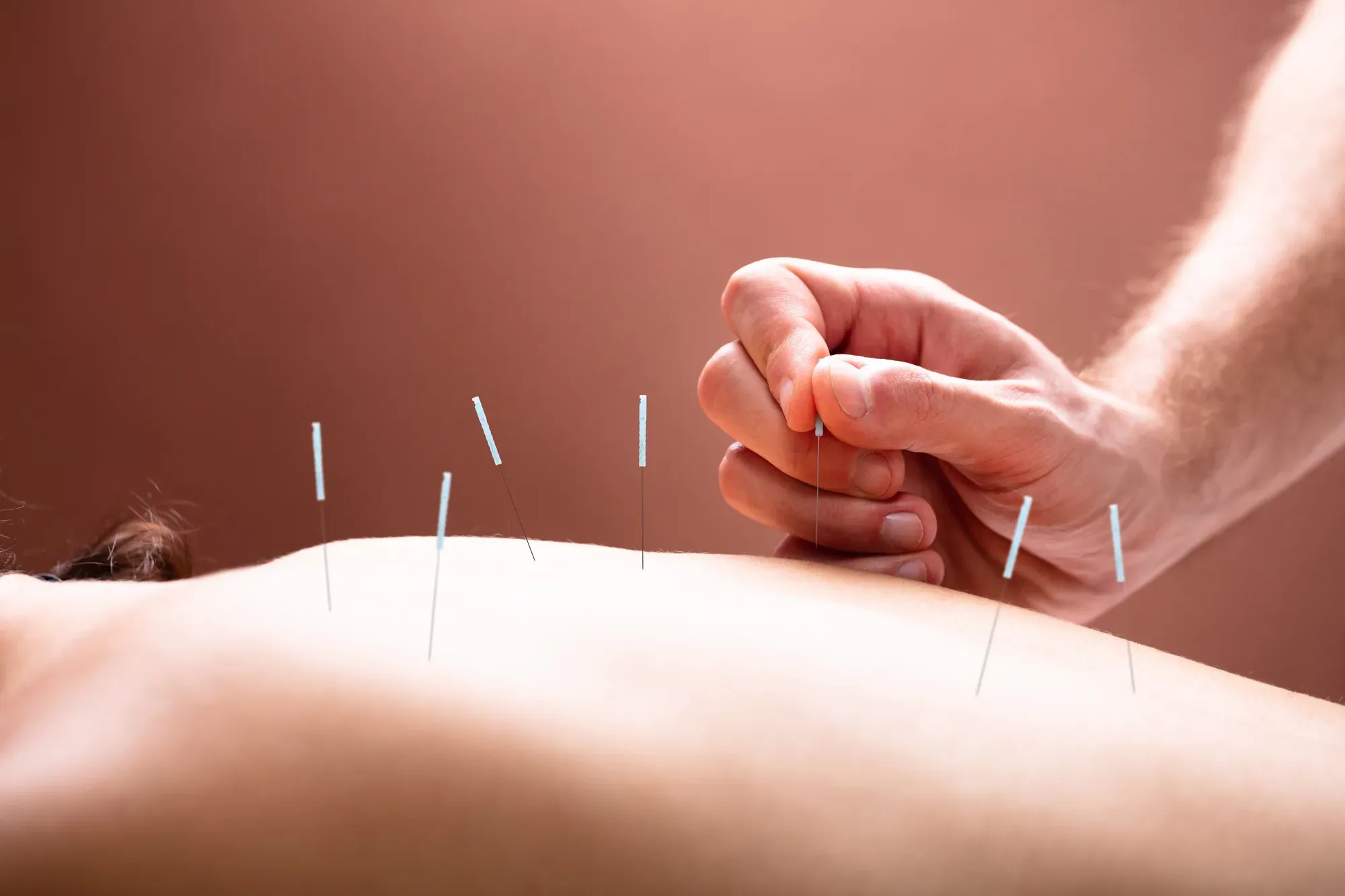 Acupuncture at Brunswick Health