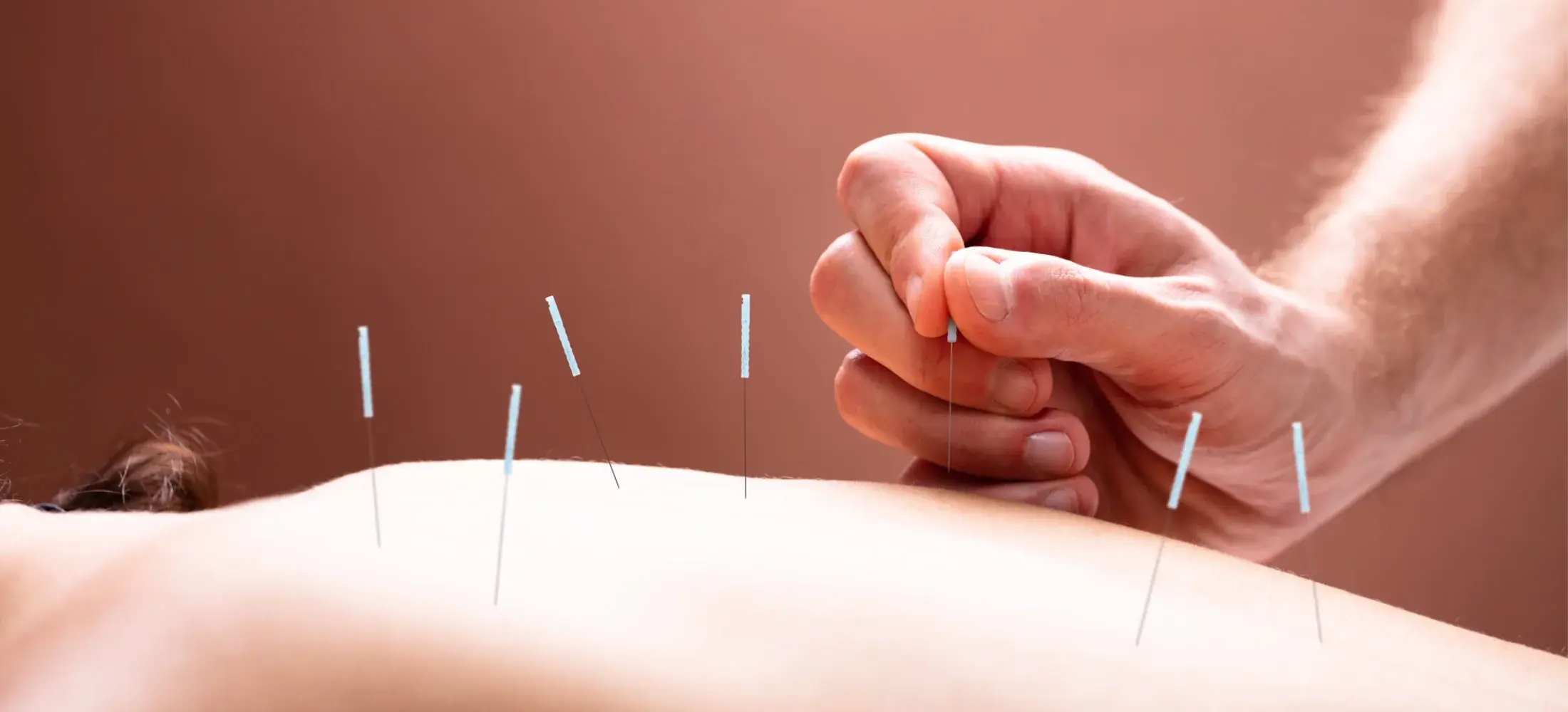 Fine needles placed along a person's back, with a hand inserting another