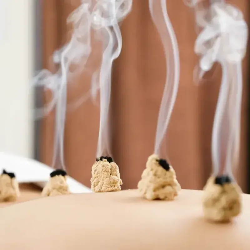 Moxibustion being applied during an acupuncture treatment