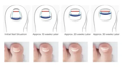 Four diagrams showing an ingrown nail flattening over roughly thirty weeks with an ONYFIX band bonded to it