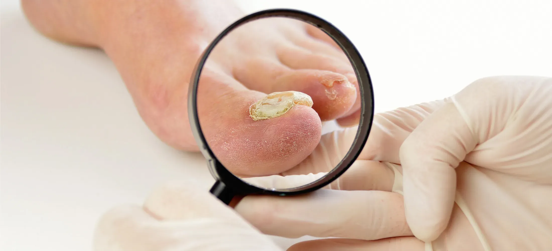 Gloved hands examining a thickened, discoloured toenail through a magnifying glass