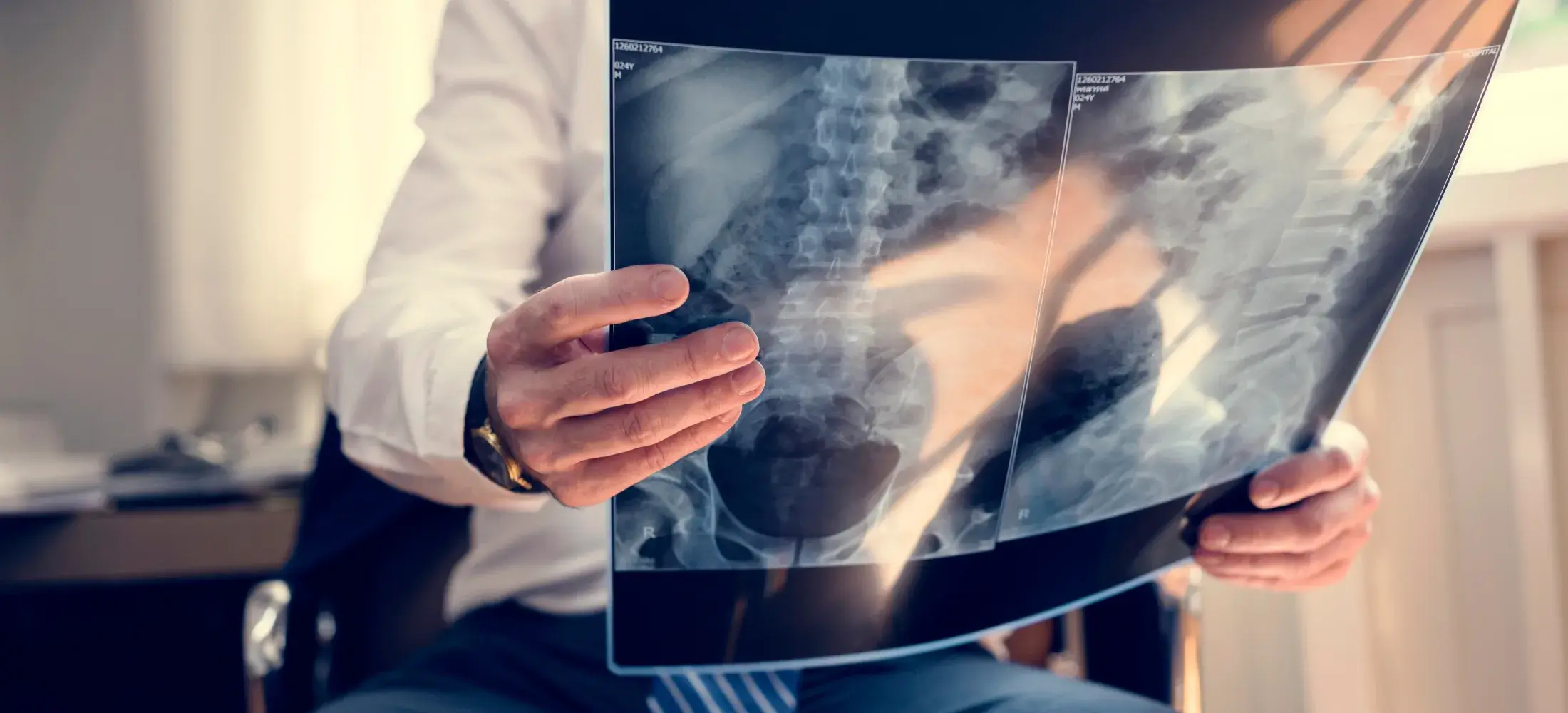 Two lumbar spine X-ray films held up to the light