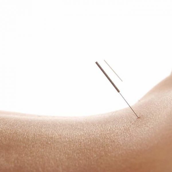 melbourne acupuncture
