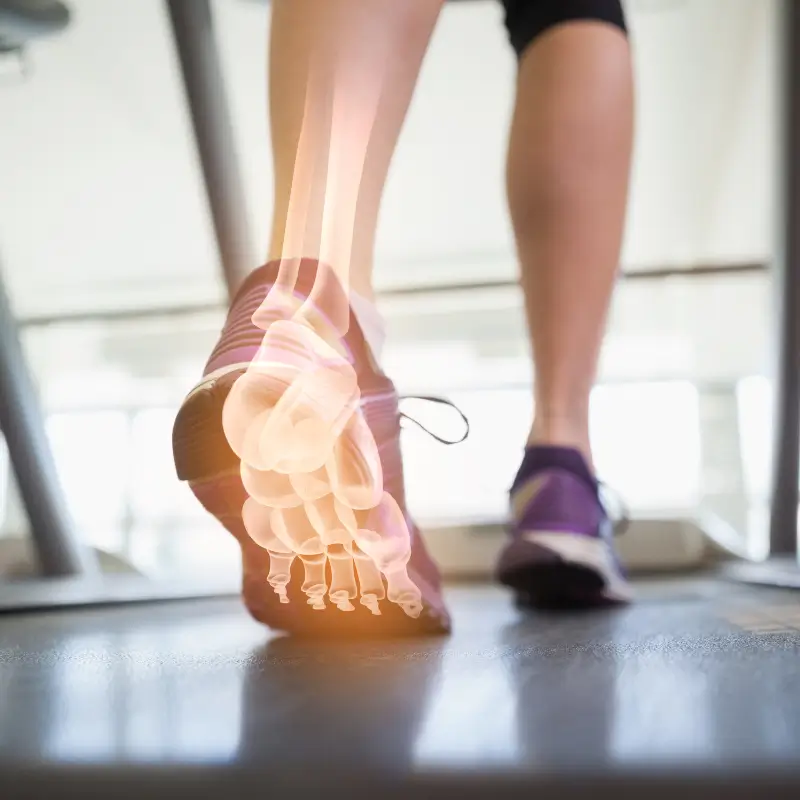 Close-up of a runner's feet on a treadmill, with a highlighted digital overlay showing the bones and muscles of the foot, emphasizing the Achilles tendon