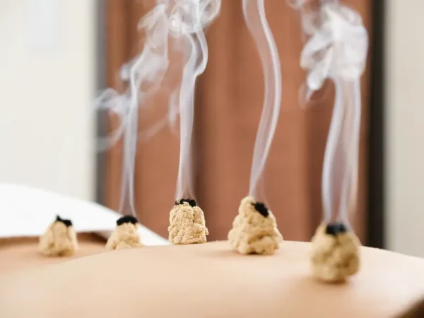 Moxibustion treatment in progress at a Melbourne acupuncture clinic