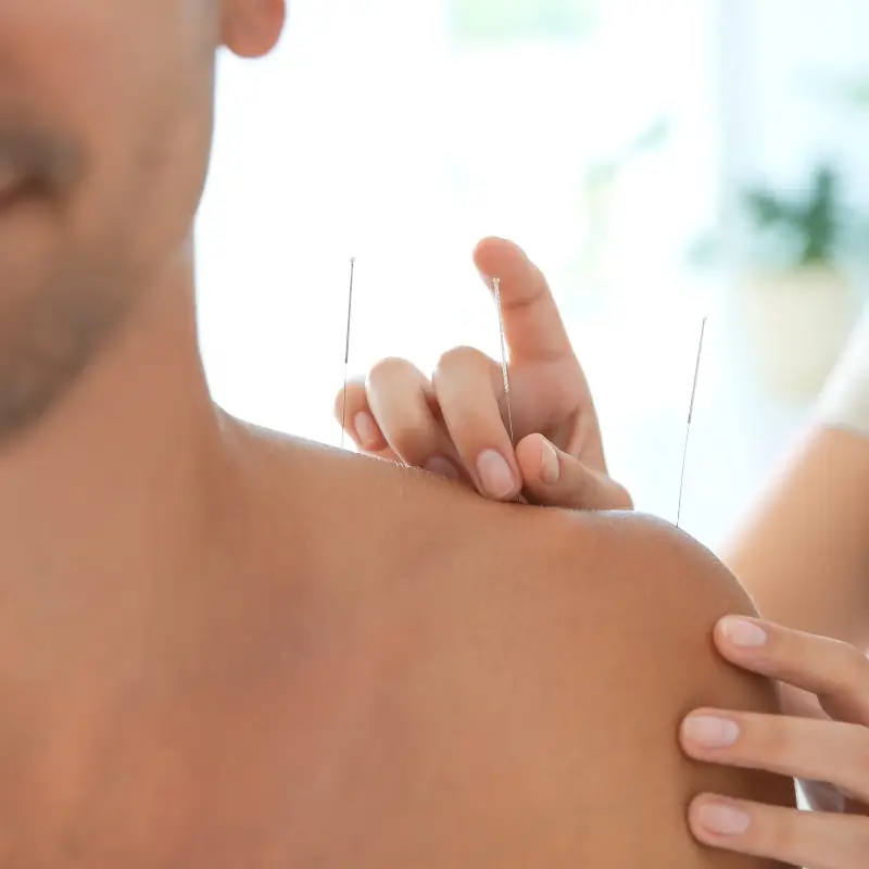 Therapist performing acupuncture or dry needling on a patient's shoulder for pain relief