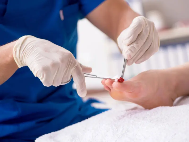 Podiatrist treating ingrown toenail in Melbourne clinic